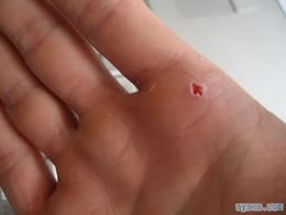Computer Mouse Injury