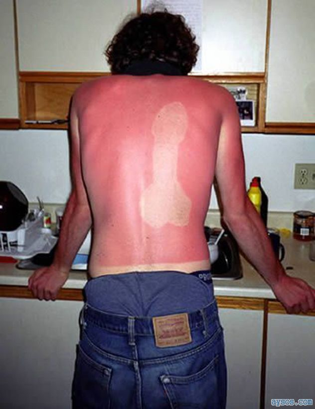 Really Bad Sunburn