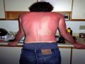 Really Bad Sunburn